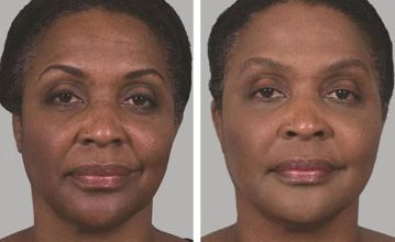 Why Choose Sculptra For Facial Rejuvenation Over Other Injectables