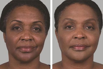 Why Choose Sculptra For Facial Rejuvenation Over Other Injectables