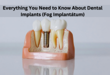 Fog Implantátum