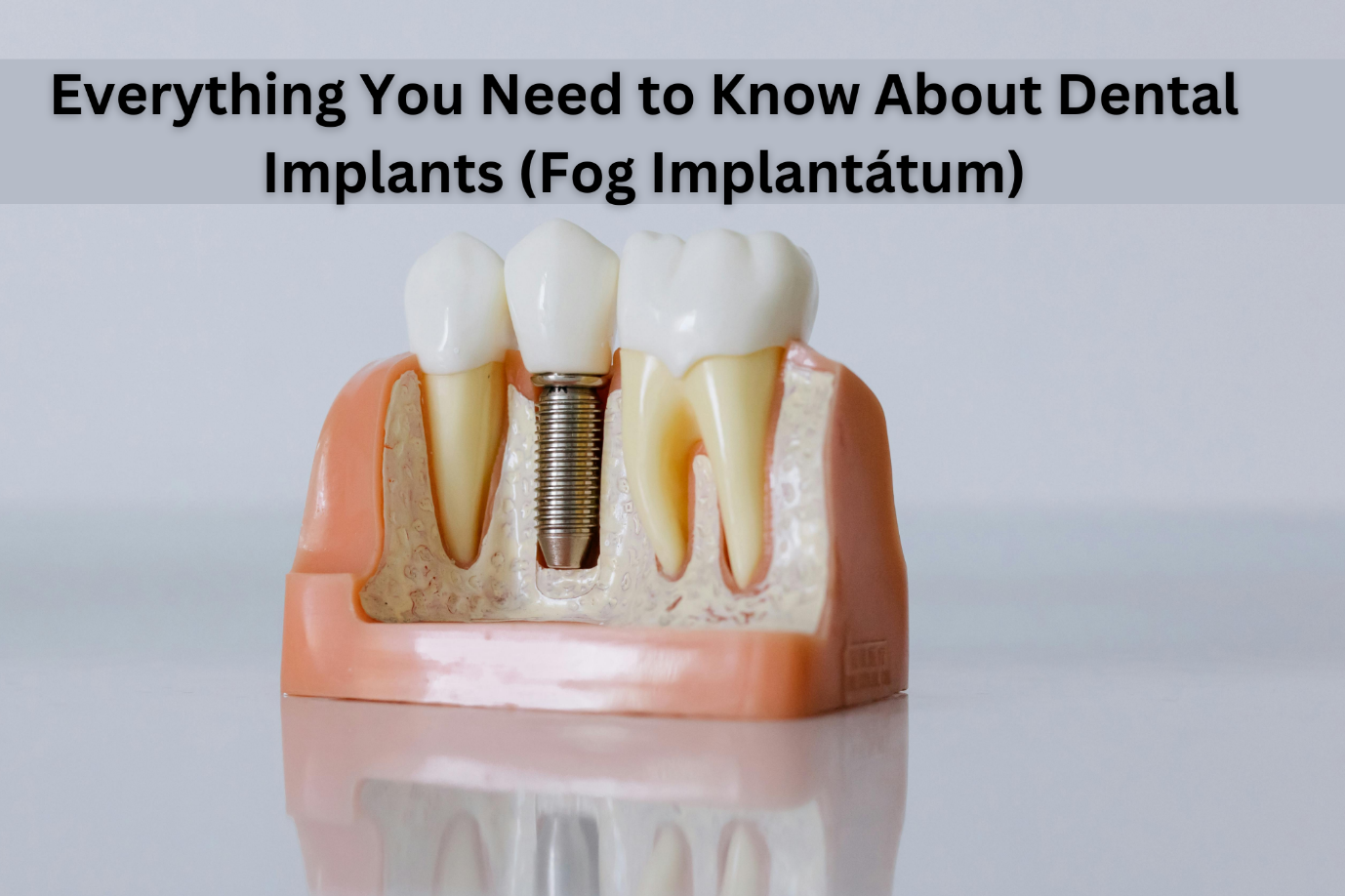 Fog Implantátum