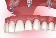 Dental Implants