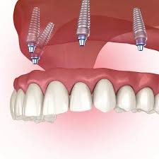 Dental Implants